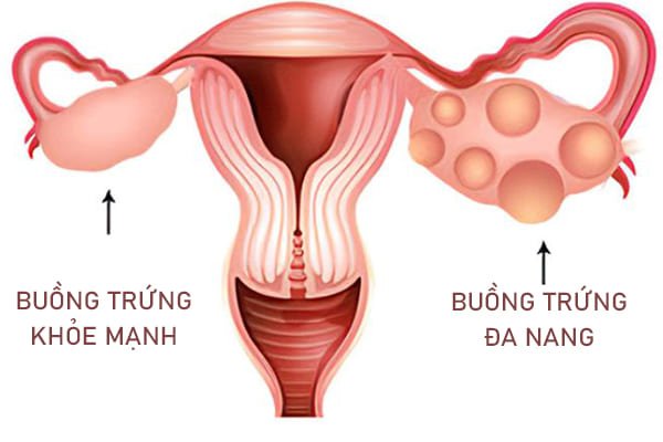 Nhận biết 5 dấu hiệu đa nang buồng trứng ở nữ giới
