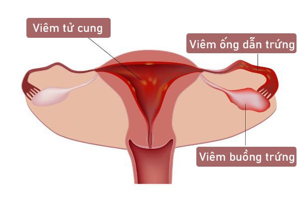 5 dấu hiệu viêm vùng chậu nữ giới không nên chủ quan 