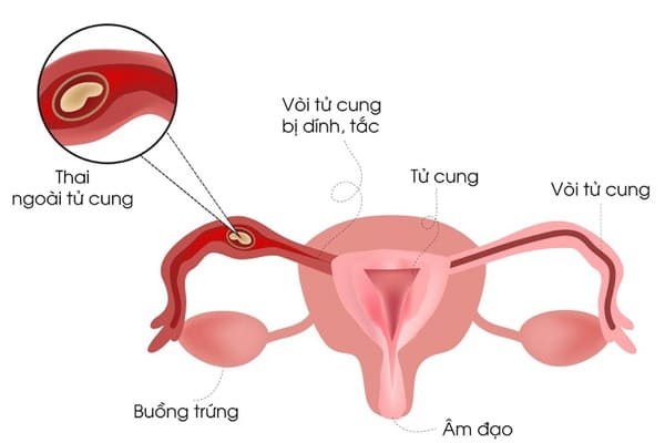 Phụ nữ bị viêm buồng trứng có thai được không?