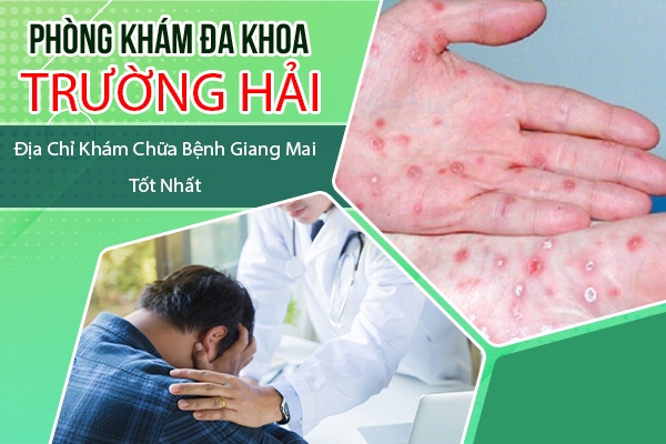 Địa chỉ chữa bệnh giang mai ở Huyện Thanh Hà hiệu quả